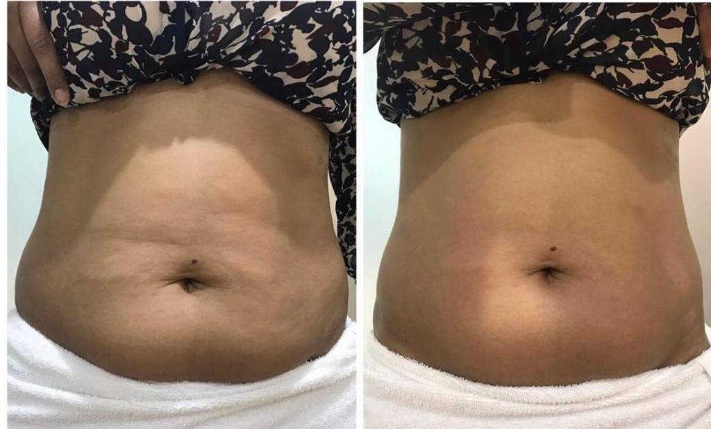 Sparha Weight Loss Treatments Best Slimming Clinic Bangalore